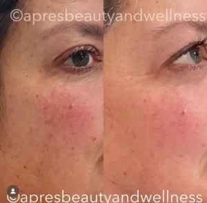 Before And After | Apres Beauty and Wellness