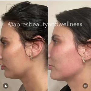 Before And After | Apres Beauty and Wellness