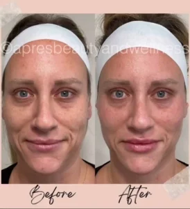 Before And After | Apres Beauty and Wellness