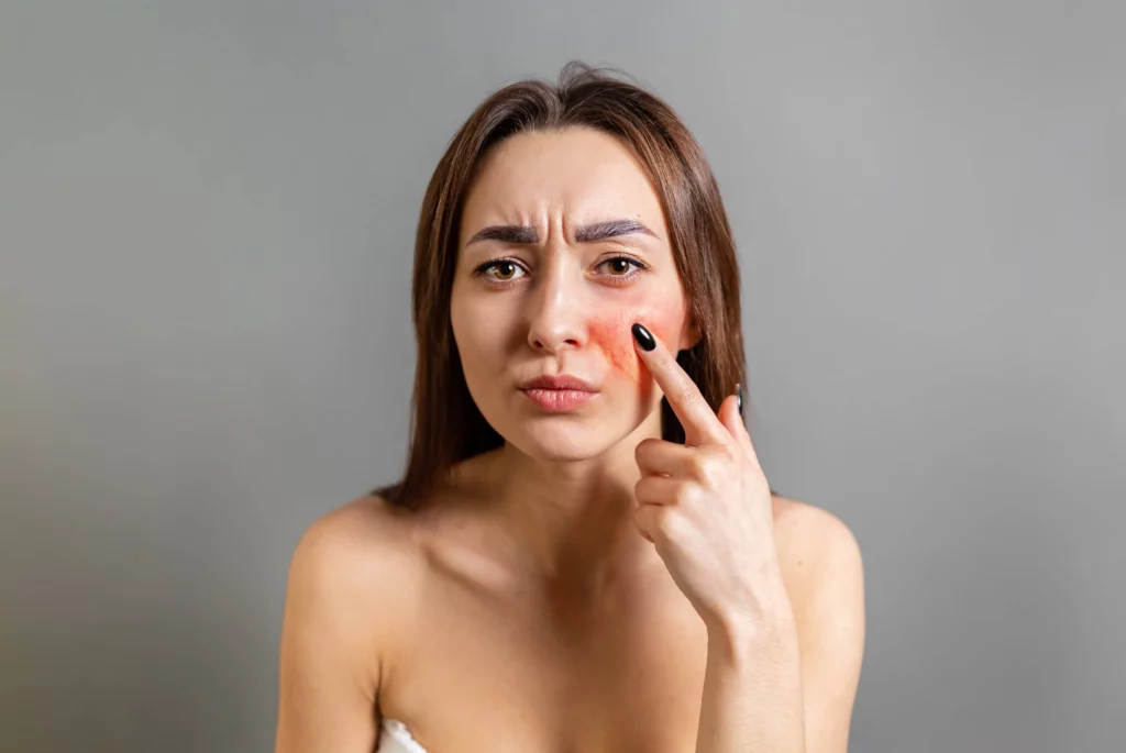 Rosacea Treatment in Sparta, NJ