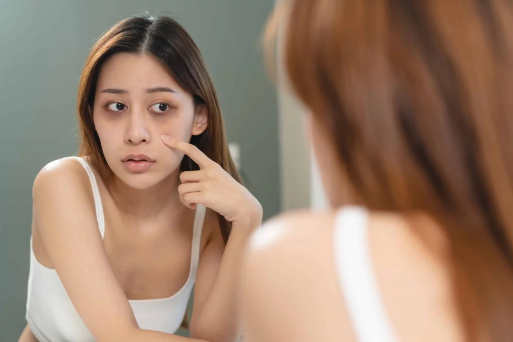 Dark Circle Treatment in Sparta, NJ