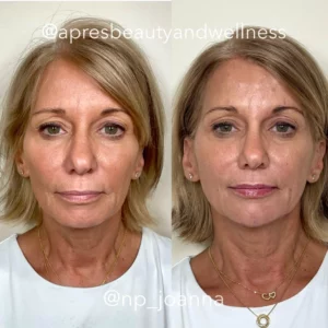Before And After | Apres Beauty and Wellness