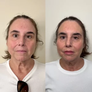 Before And After | Apres Beauty and Wellness