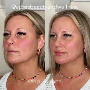 Before And After | Apres Beauty and Wellness
