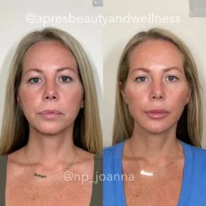 Before And After | Apres Beauty and Wellness