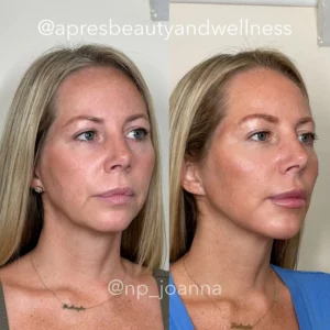 Before And After | Apres Beauty and Wellness
