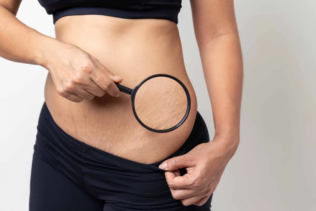 Stretch Marks Removal in Sparta, NJ