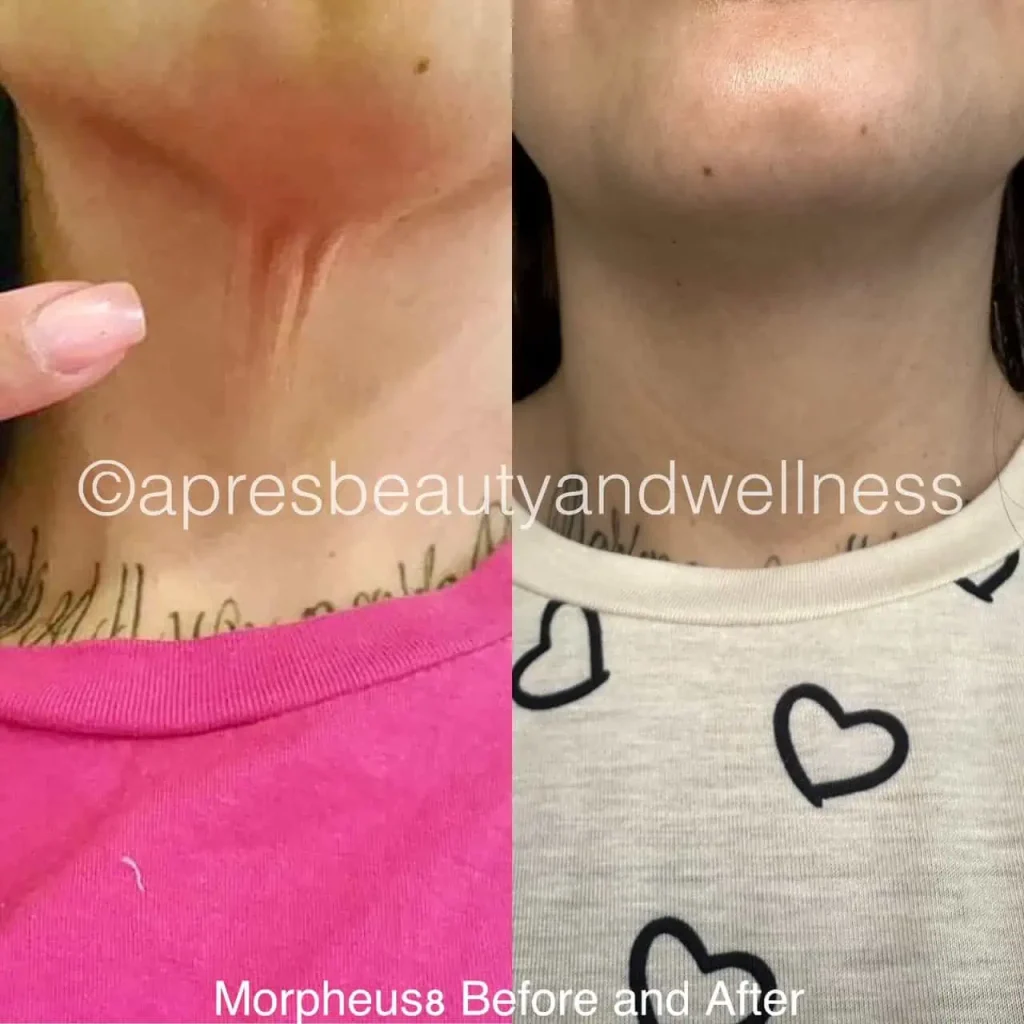 Morpheus8 RF microneedling neck skin tightening before and after results at Apres Beauty and Wellness Sparta NJ