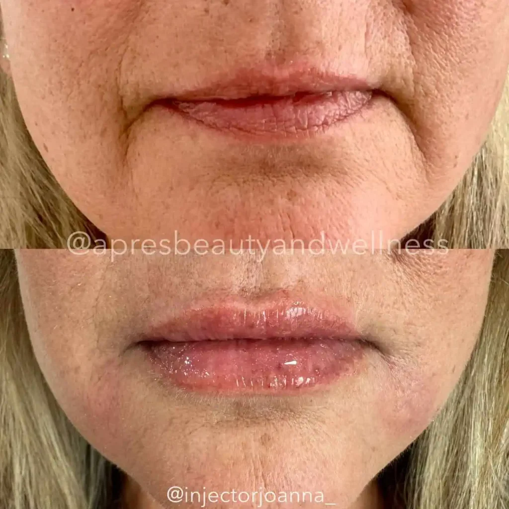 Lip filler and perioral wrinkle treatment before and after results at Apres Beauty and Wellness Sparta NJ