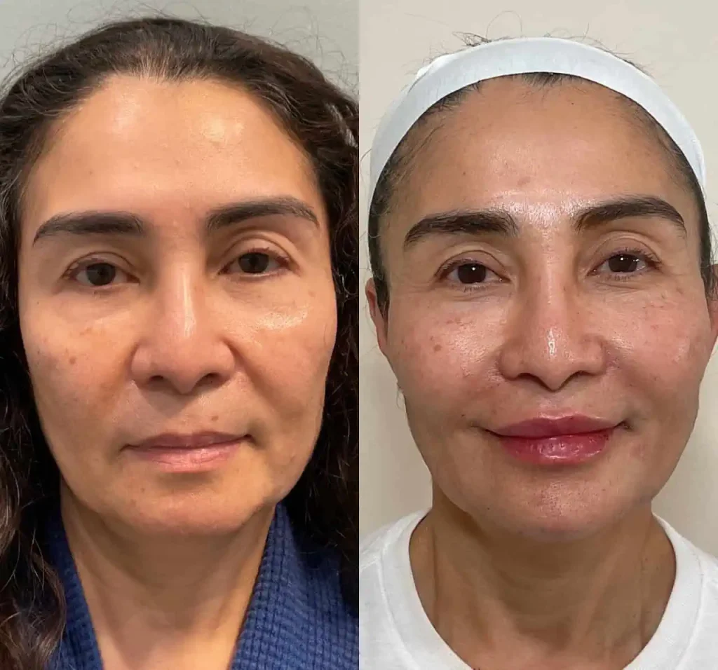 Full face rejuvenation dermal filler treatment before and after results at Apres Beauty and Wellness Sparta NJ