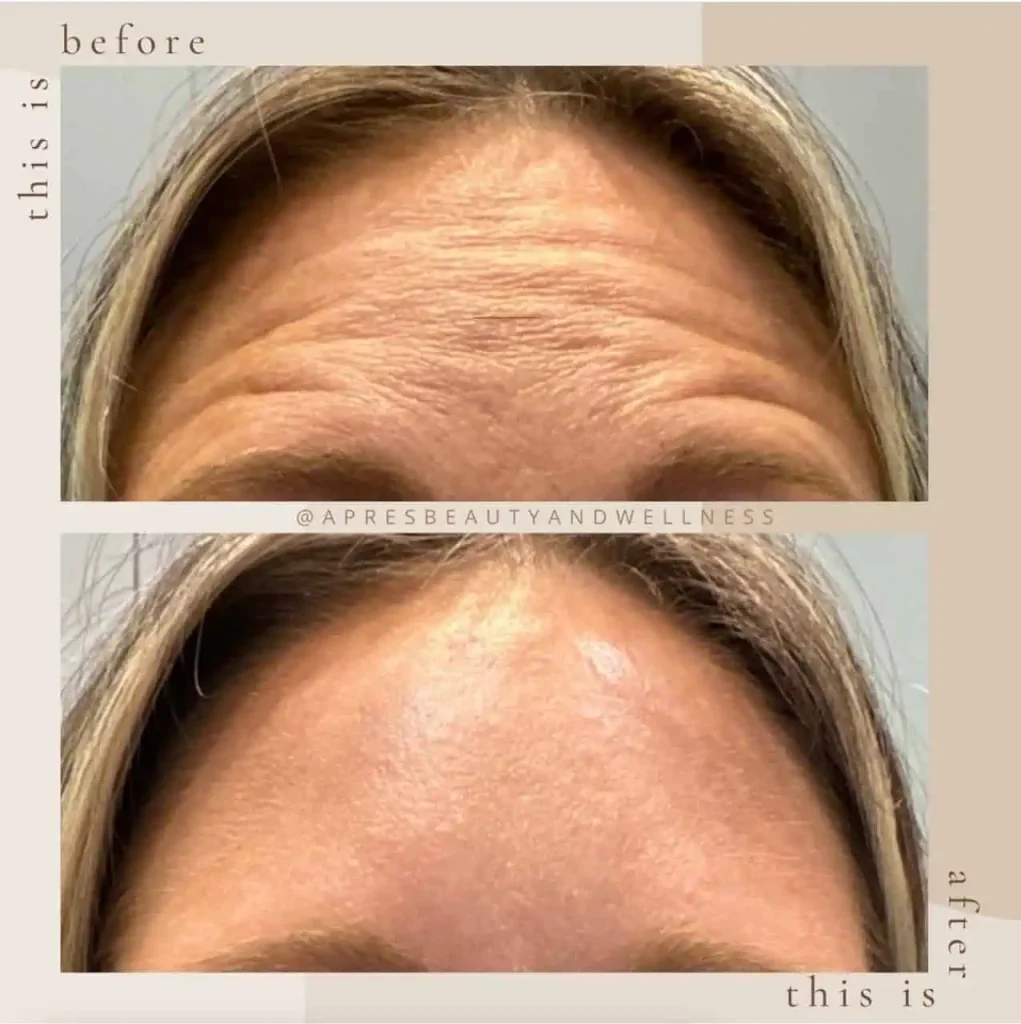 1.webpBotox forehead lines treatment before and after results at Apres Beauty and Wellness Sparta NJ