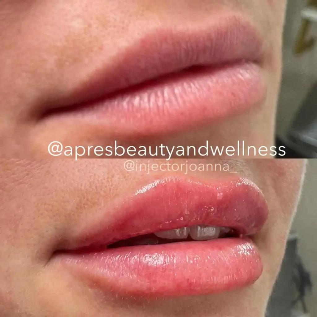 Lip filler treatment before and after close up results at Apres Beauty and Wellness Sparta NJ