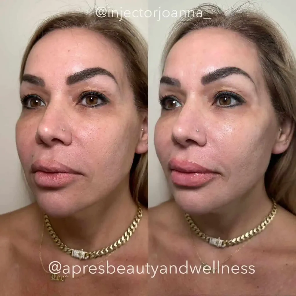 Full face dermal filler facial contouring before and after results at Apres Beauty and Wellness Sparta NJ