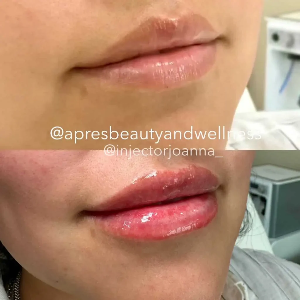 Lip filler treatment before and after close up results at Apres Beauty and Wellness Sparta NJ