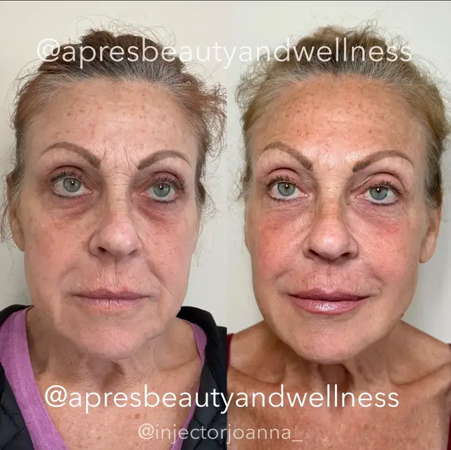 Full face dermal filler anti-aging treatment before and after results at Apres Beauty and Wellness Sparta NJ