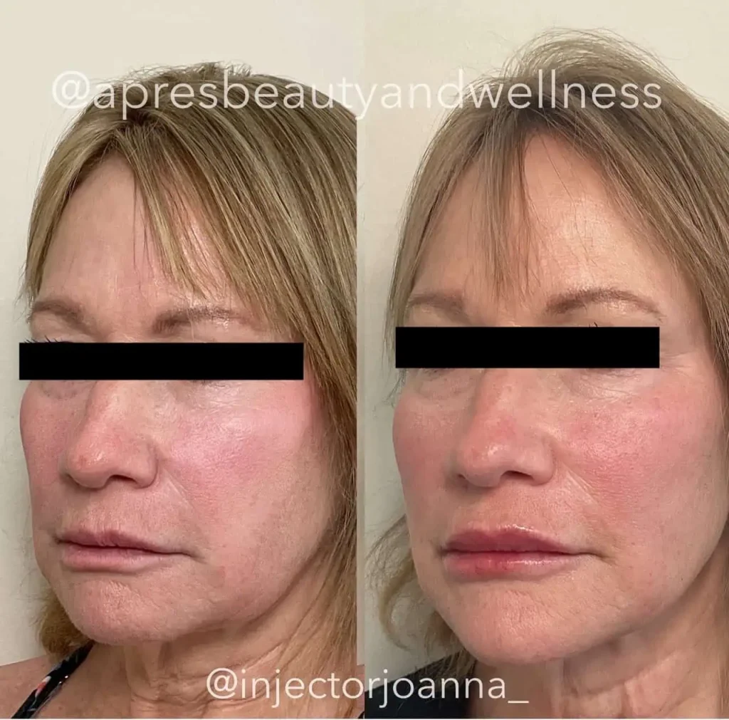 Dermal filler facial rejuvenation before and after results at Apres Beauty and Wellness Sparta NJ