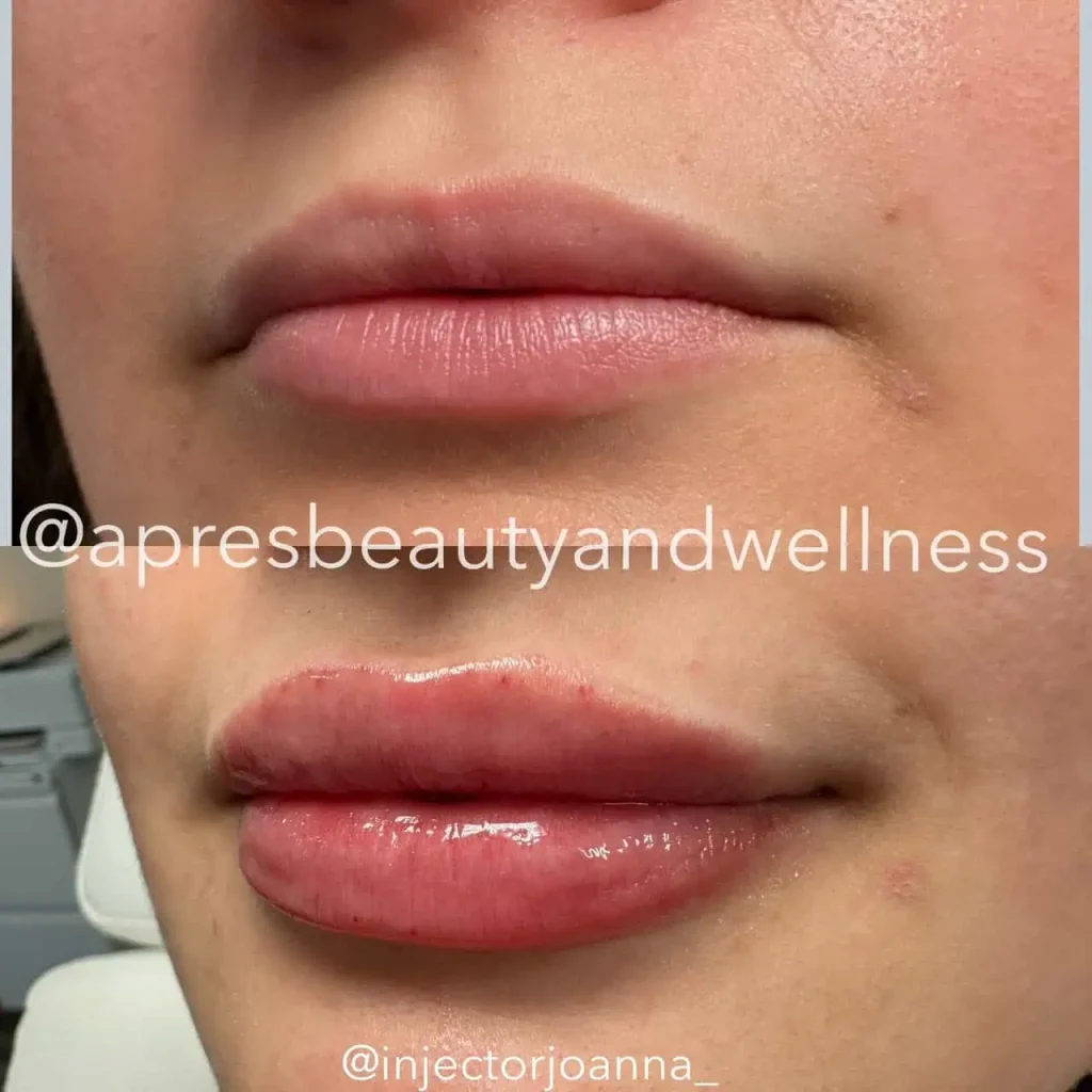 Lip filler treatment before and after close up results at Apres Beauty and Wellness Sparta NJ