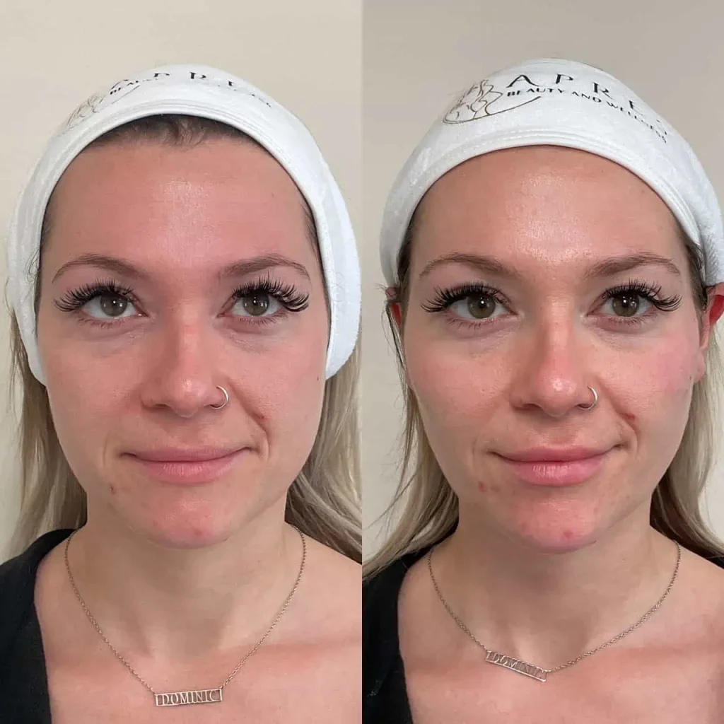 Facial treatment skin glow before and after results at Apres Beauty and Wellness Sparta NJ