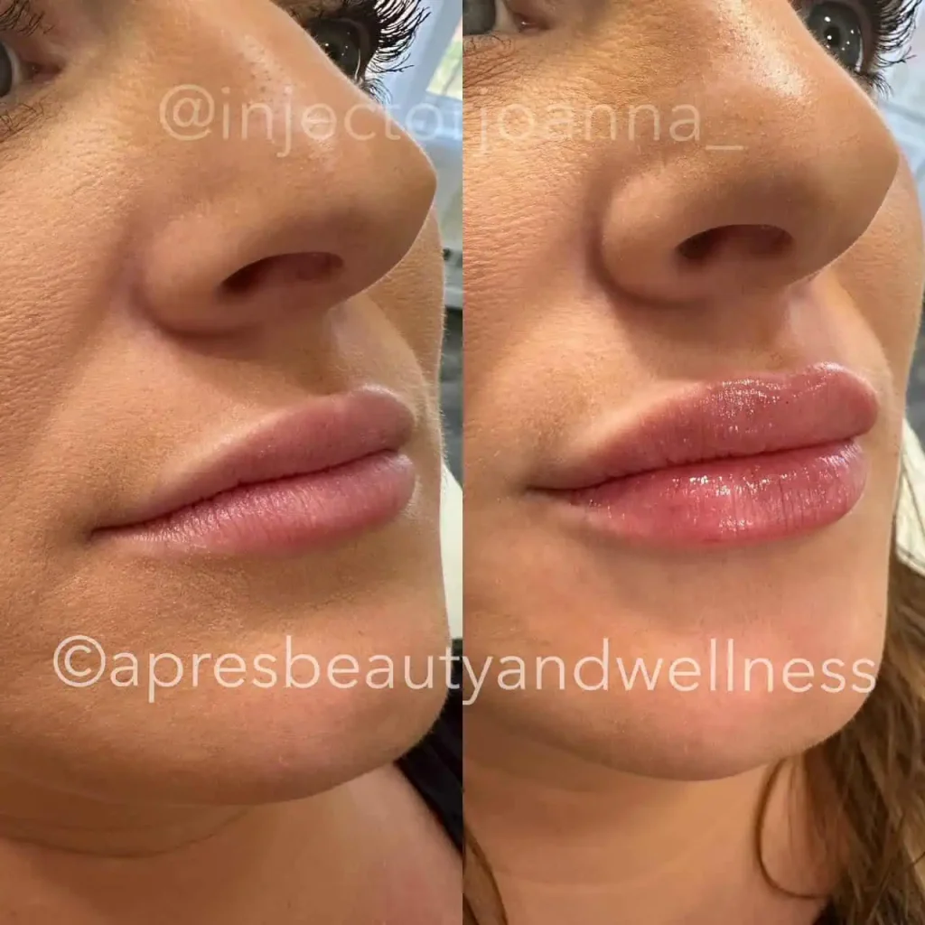 Lip filler volume enhancement before and after results at Apres Beauty and Wellness Sparta NJ